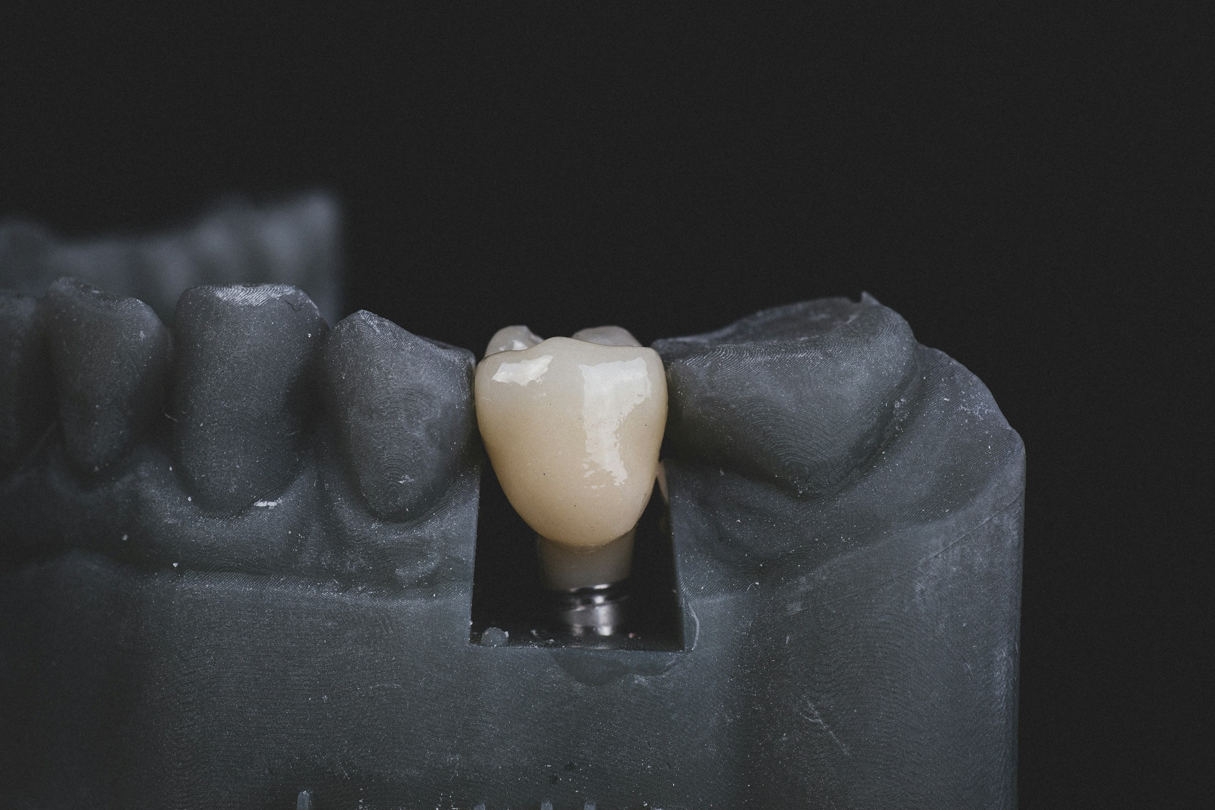 implantologia impianto dentale carico immediato